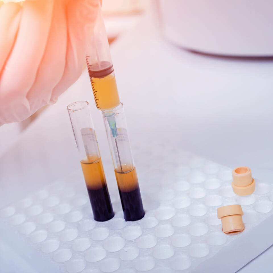 platelet rich plasma UME Health Private Clinic Harley Street